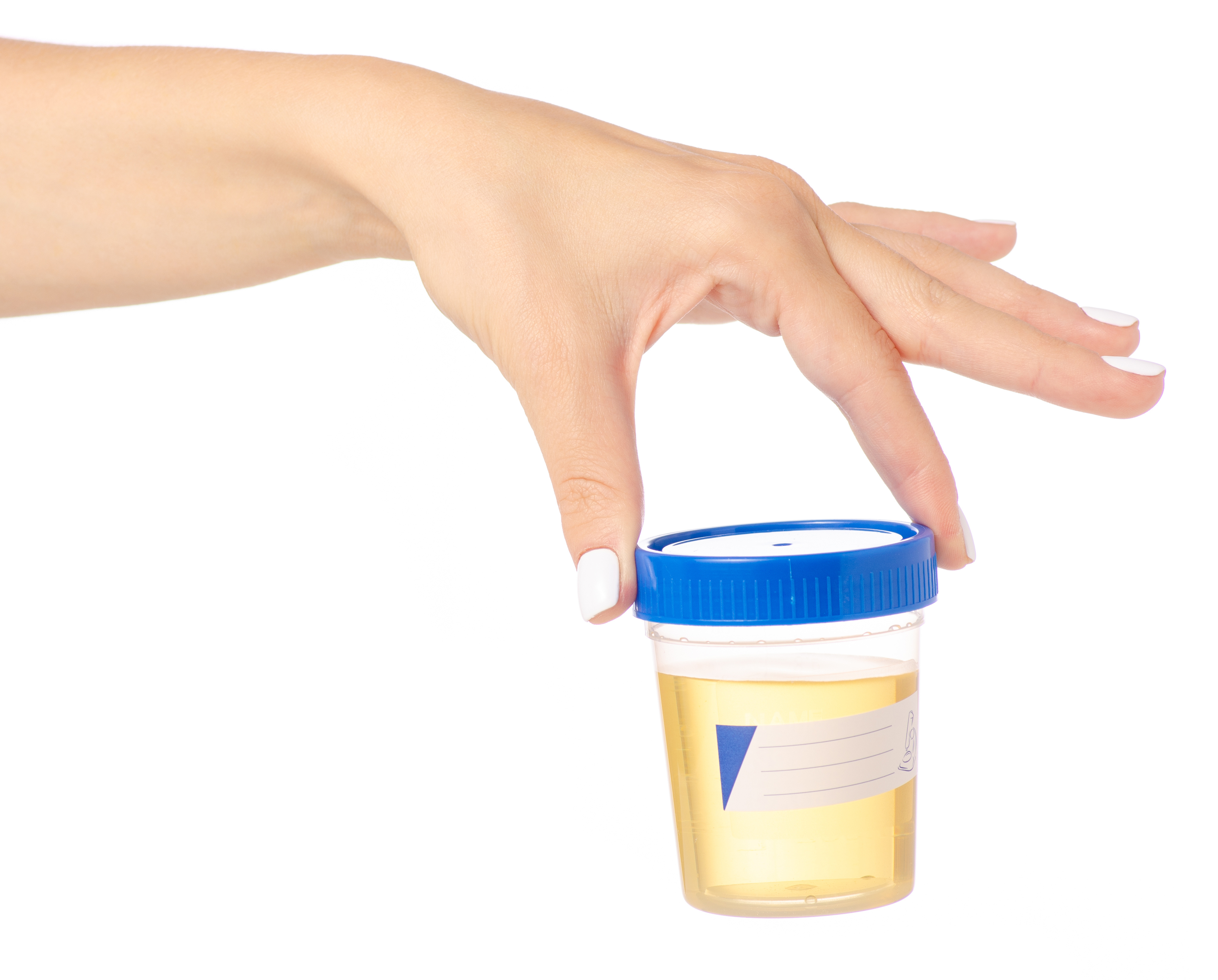 Hand hält gefüllten Urinprobenbecher