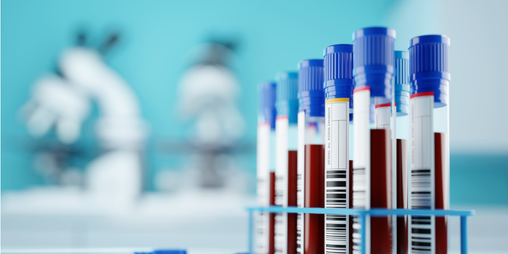mit Blut gefüllte Probenröhrchen