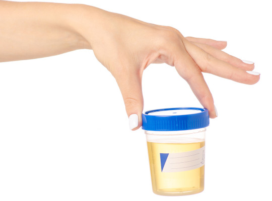 Hand hält gefüllten Urinprobenbecher